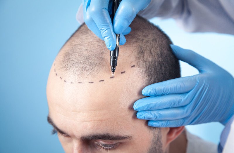 Haartransplantation in Hannover wird vorbereitet