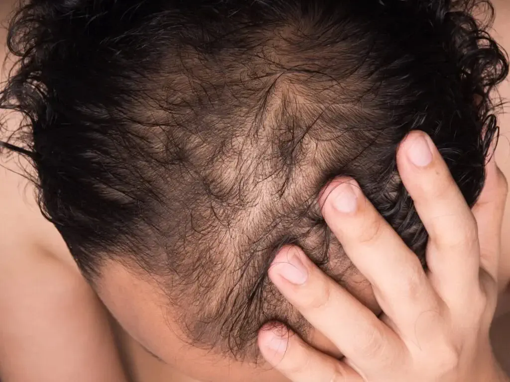 Kopfhaut von einem Mann vor einer Haartransplantation