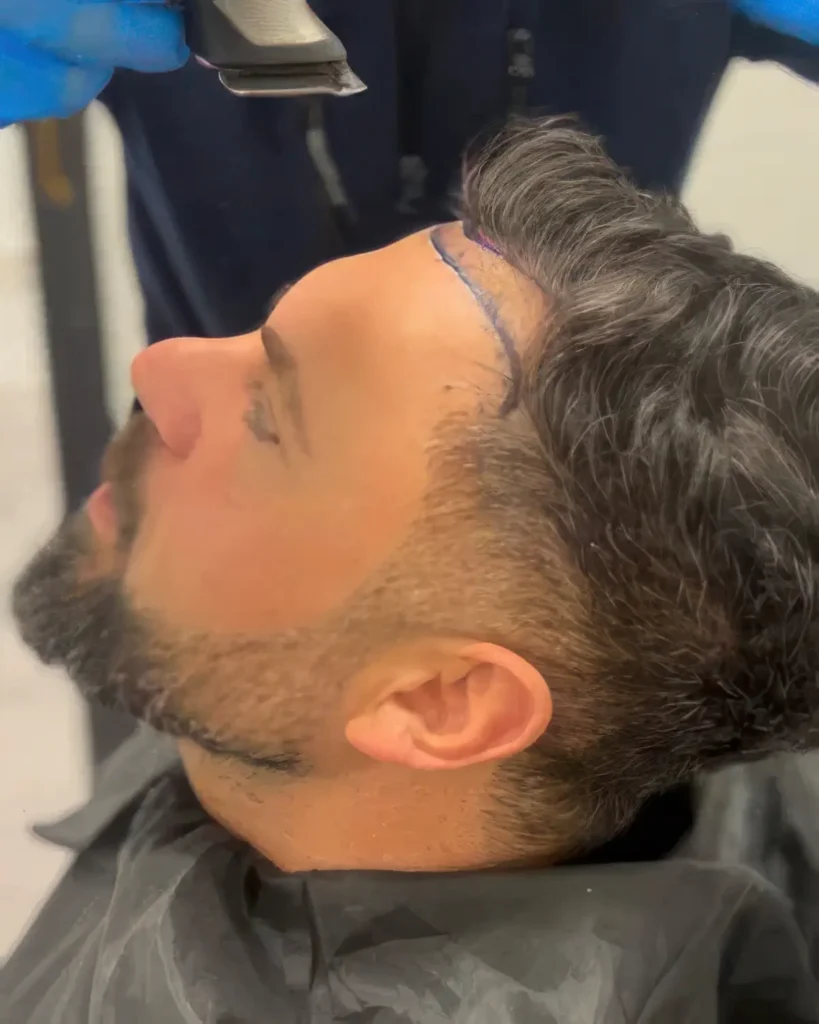 haartransplantation-startseite-sm-3-topaz-enhance-faceai