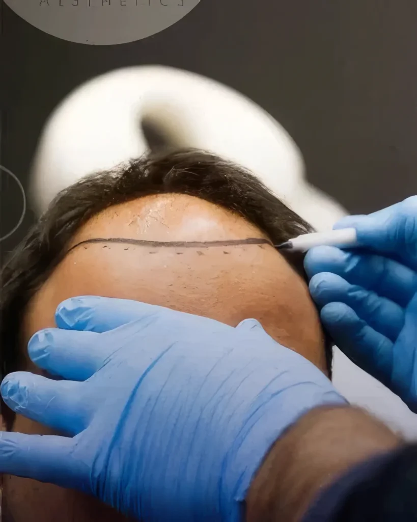 haartransplantation-startseite-sm-6-topaz-enhance