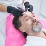 haartransplantation gottingen