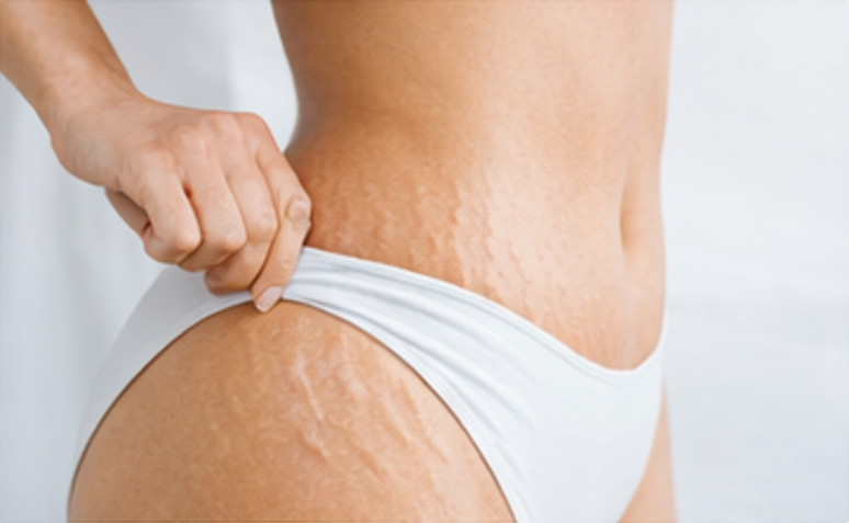 Körper (Dehnungsstreifen)