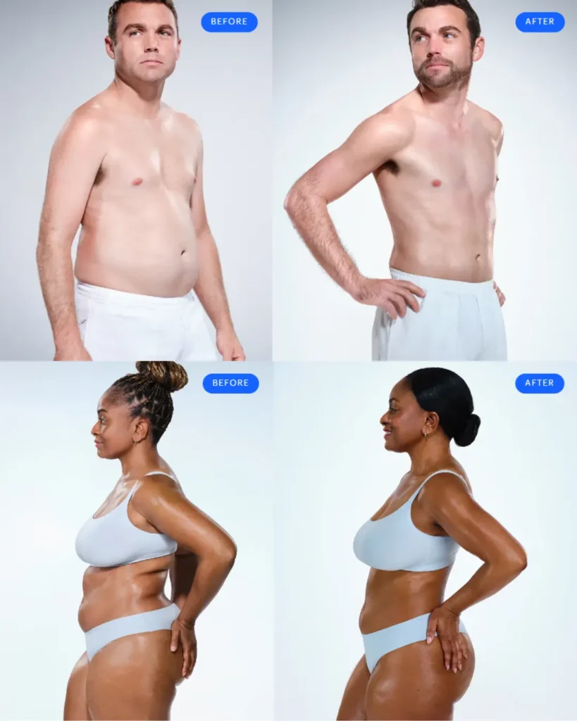 Coolsculpting-vorher-nachher