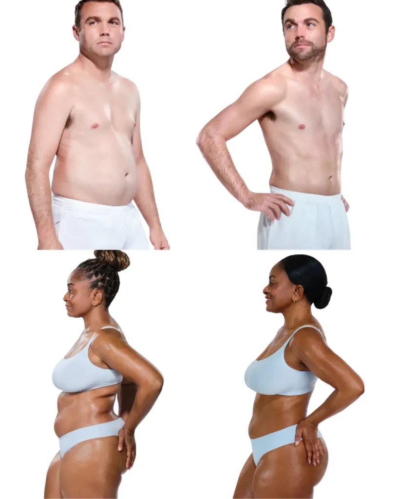 Coolsculpting-vorher-nachher