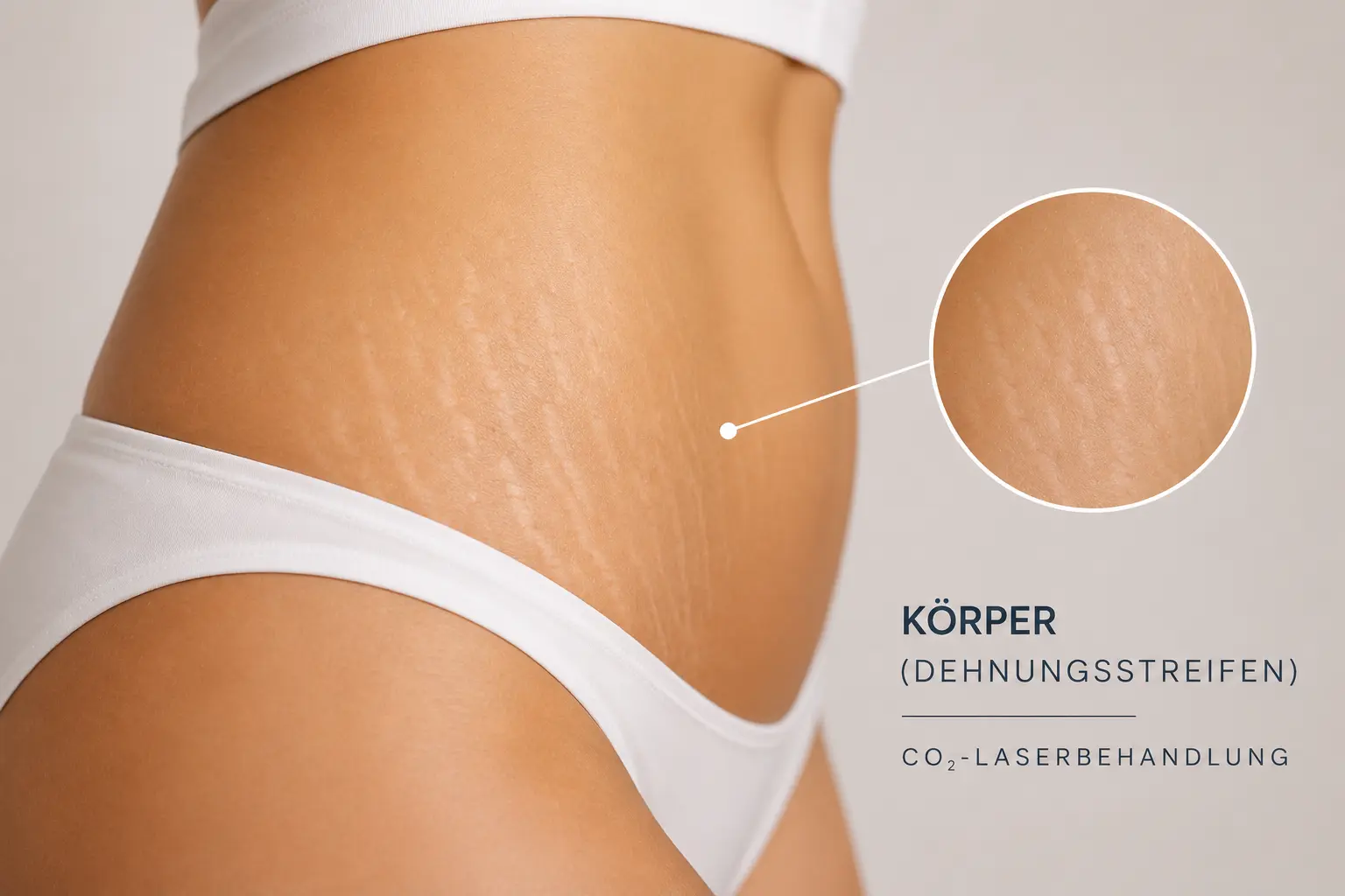 Körper (Dehnungsstreifen)