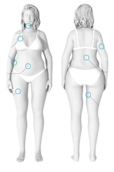 Hamburg CoolSculpting